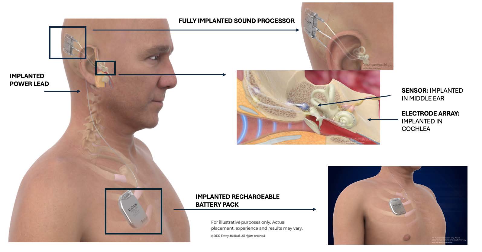 Acclaim Hearing Device Image